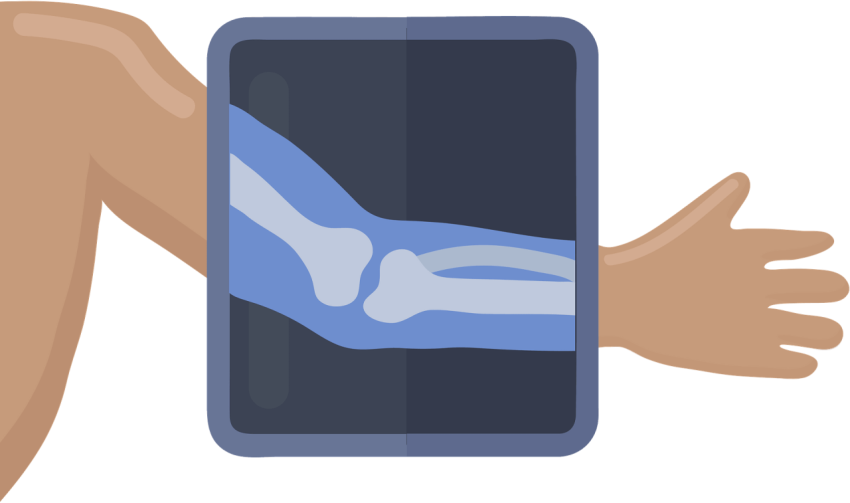 Arm X Ray PNG Image Free Download