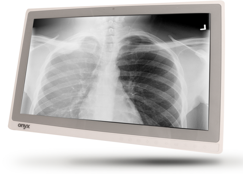 Lungs X Ray PNG Monitor Free Download