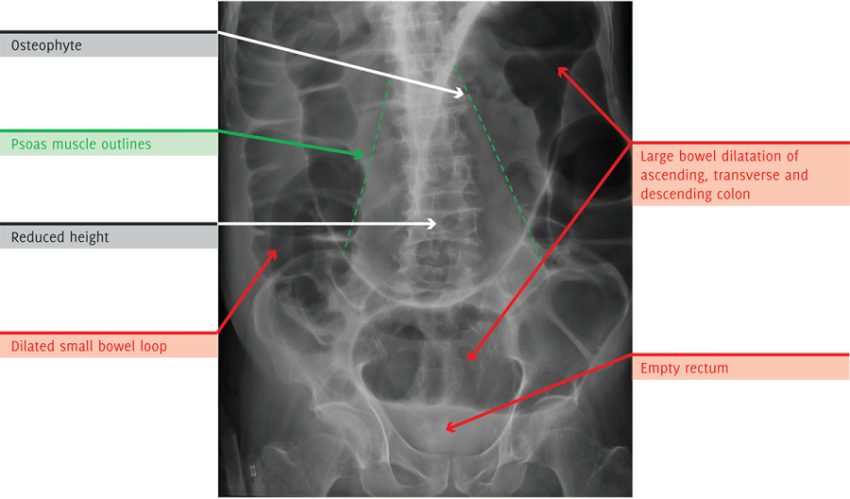 Bones X Ray PNG Image Free Download